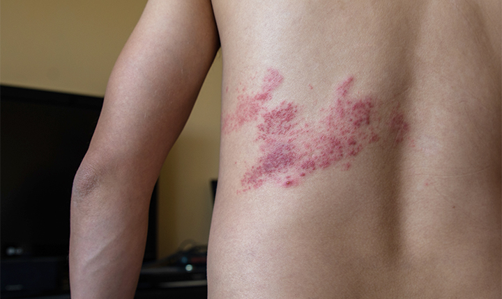 Gürtelrose Hautausschlag Rücken